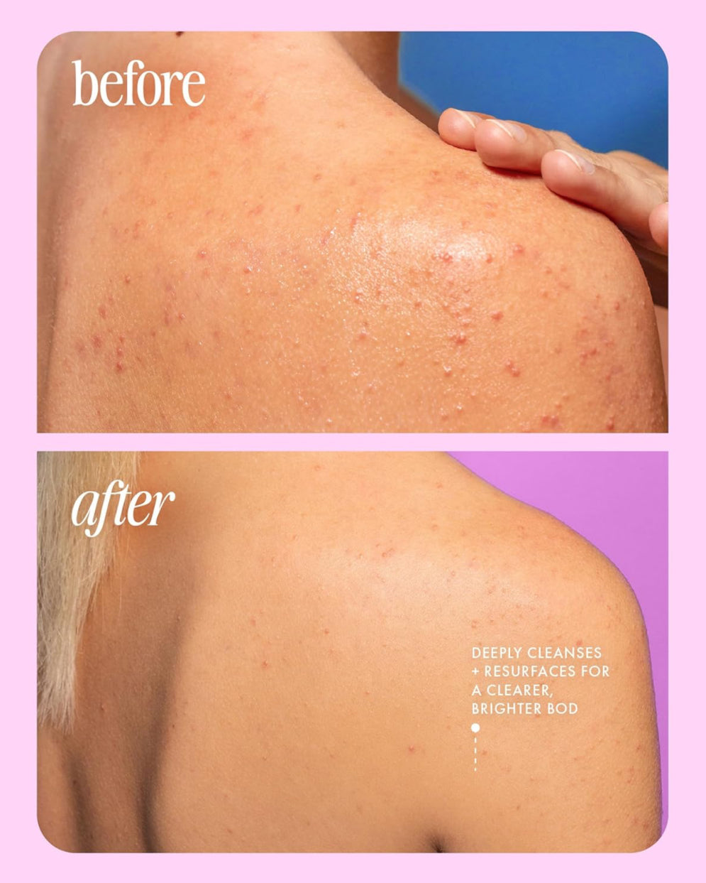 Truly Cherry Jelly Anti-Bacne Body Cleanser - Jabón Corporal
